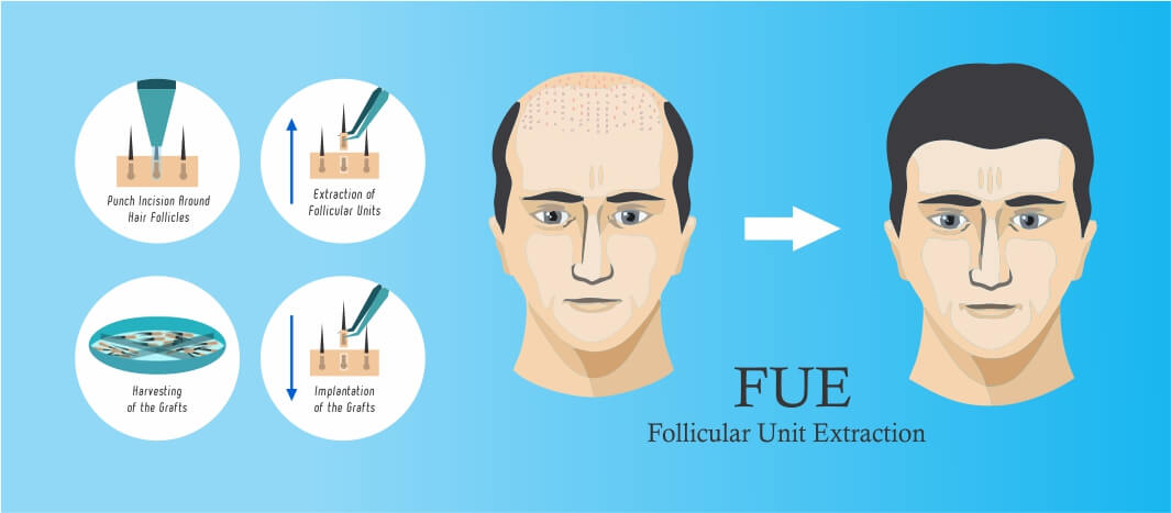 Regain Hair Clinic FUE Hair Transplant Regain Hair FUE Hair Transplant