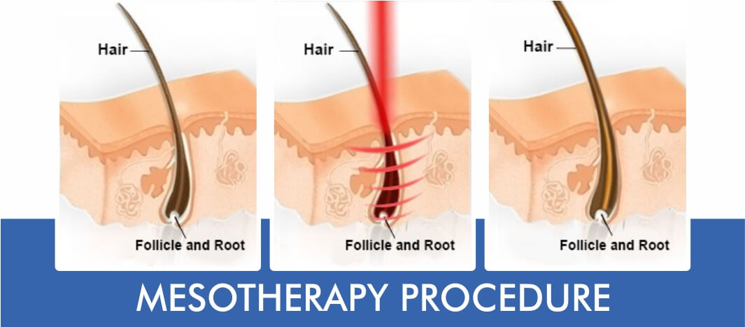 Regain Hair Clinic Hair Line Design Regain Hair Line Design