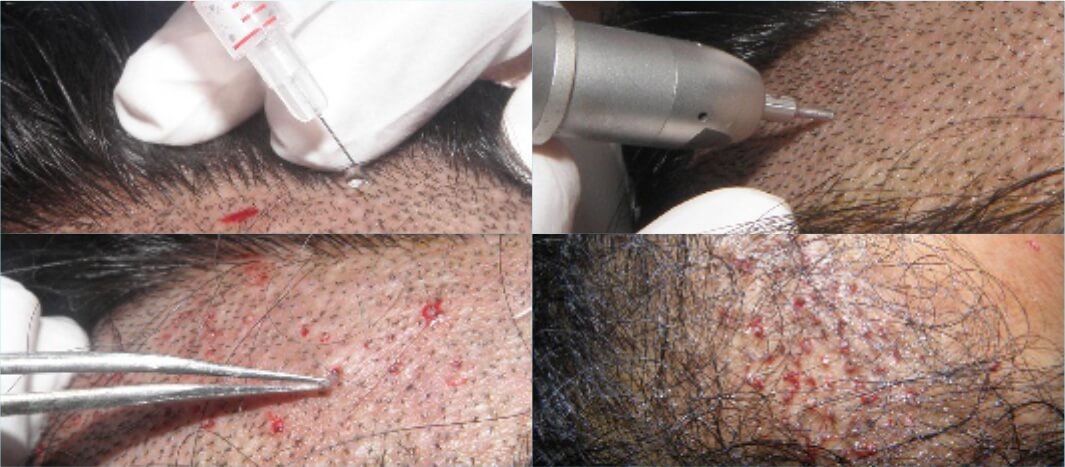 Regain Hair Clinic Unshaven FUE Hair Transplant Regain Hair Unshaven FUE Hair Transplant